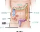 慢性直肠炎的症状及治疗方法
