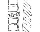 脊柱脊髓伤的疾病护理