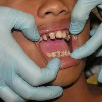 整牙铁丝磨腮正常么,整牙铁丝磨腮的护理