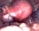 胃肠间质肿瘤