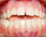 甲硝锉治牙龈炎有效果吗
