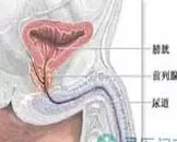 膀胱嗜铬细胞瘤的饮食禁忌_膀胱嗜铬细胞瘤的典型症状