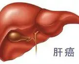 肝癌AFP升高是肝癌的信号