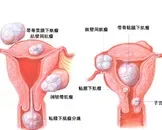 子宫肌瘤九成以上生长于子宫体部