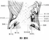 腰疝病症的介绍,腰疝有什么饮食禁忌