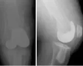 股骨骨折如何急救_,股骨干骨折的护理