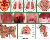 化脓性扁桃体炎治疗