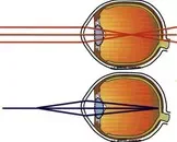 遗传性近视的病症是什么