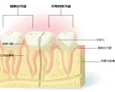 牙周病发生的信号有哪些