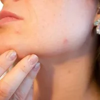 皮肤感染湿疹能吃韭菜吗,皮肤感染湿疹怎么治疗