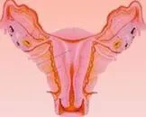 肠道子宫内膜异位症的临床表现