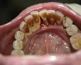 根尖牙周炎怎么表现？