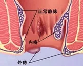 痔疮反复出血怎么解决