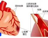 心肌桥就是心脏病吗