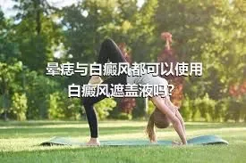 晕痣与白癜风都可以使用白癜风遮盖液吗？