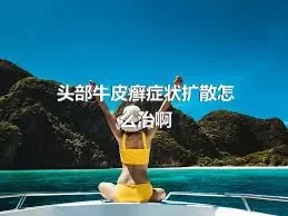 头部牛皮癣症状扩散怎么治啊