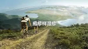 疱疹样湿疹