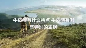 牛皮癣有什么特点 牛皮癣有哪些特别的表现